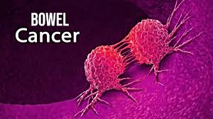 Bowel Cancer